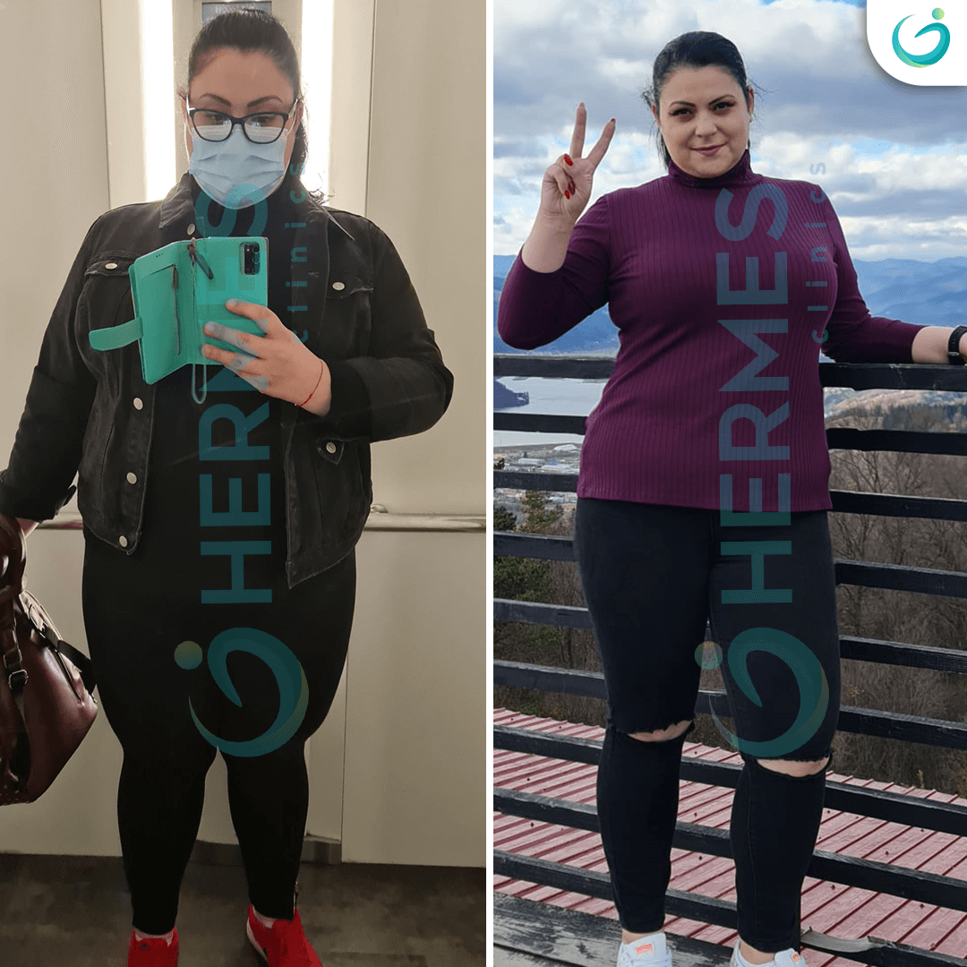 hermes before after (11)