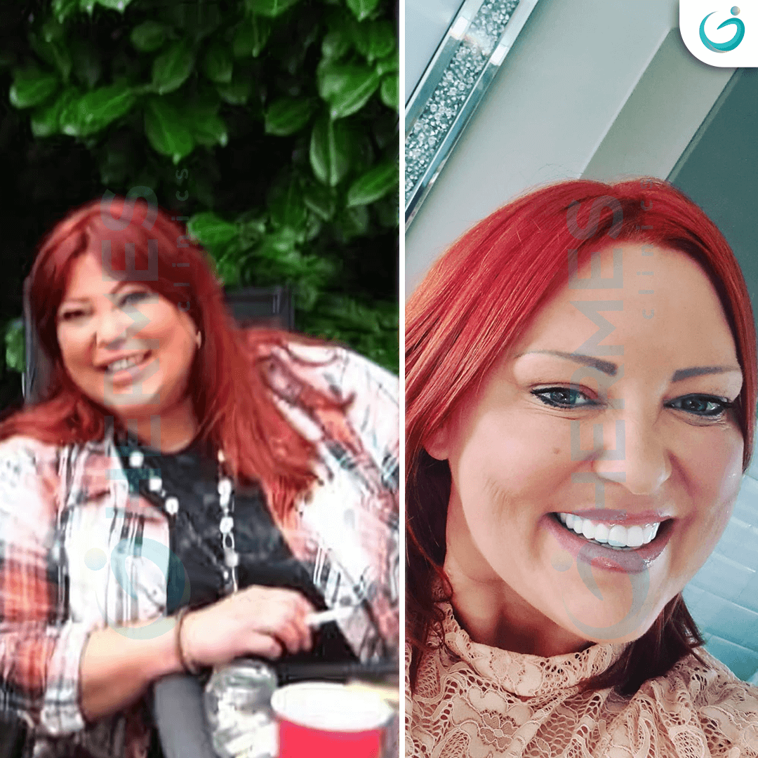 hermes before after (14)