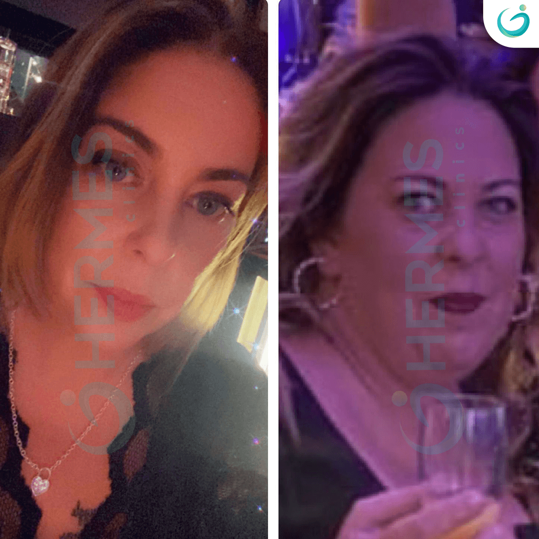 hermes before after (15)