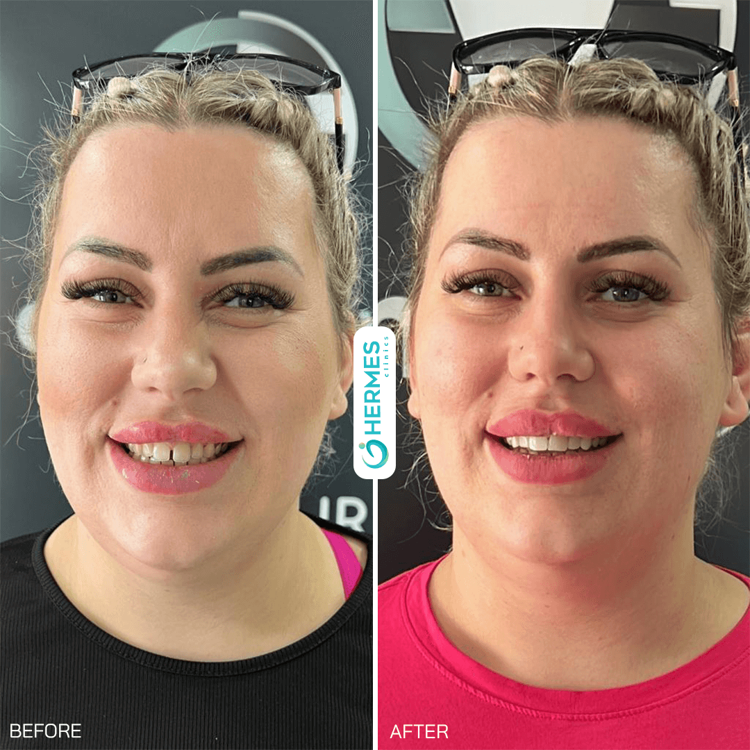 hermes before after (16)