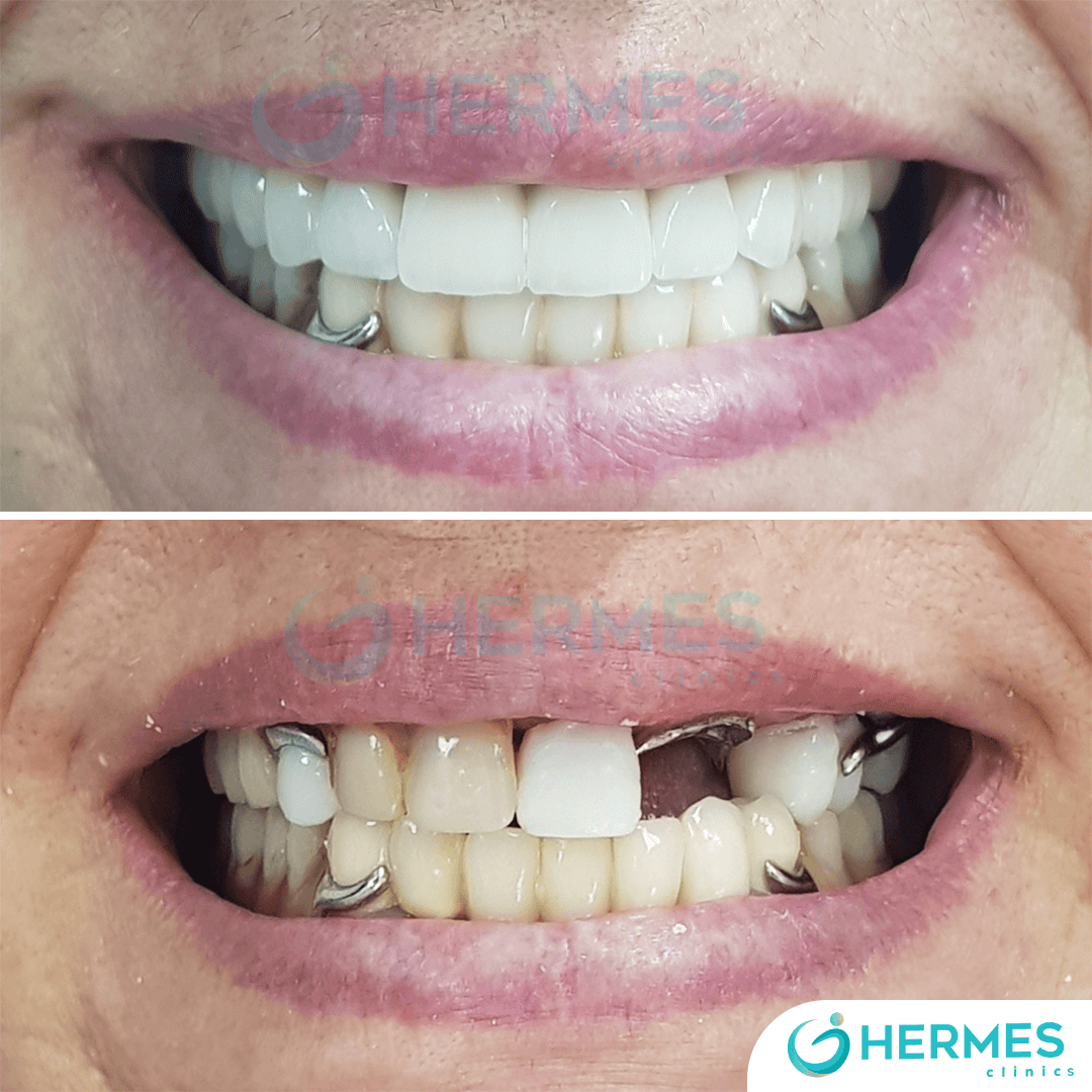 hermes before after (17)