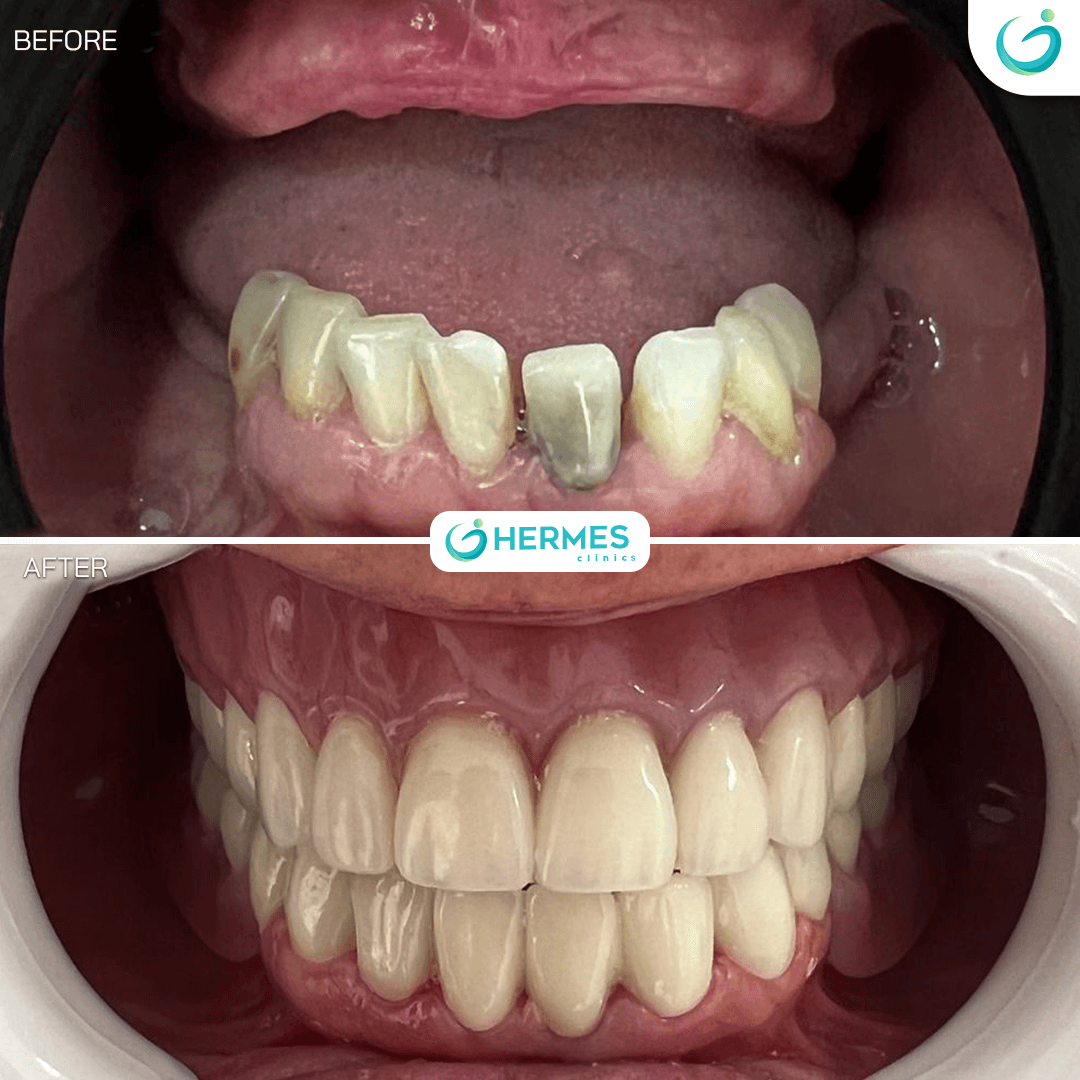 hermes before after (18)