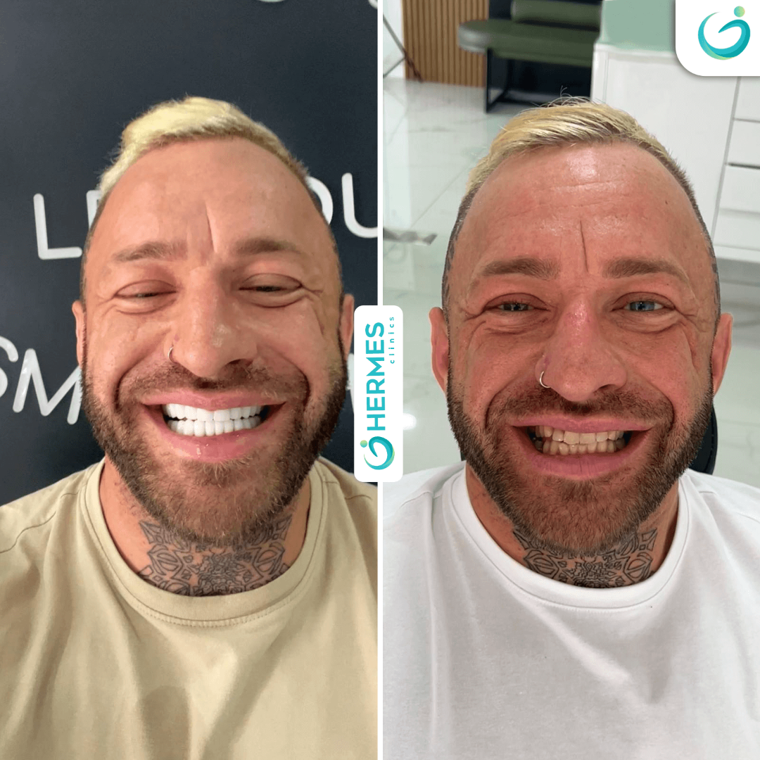 hermes before after (19)