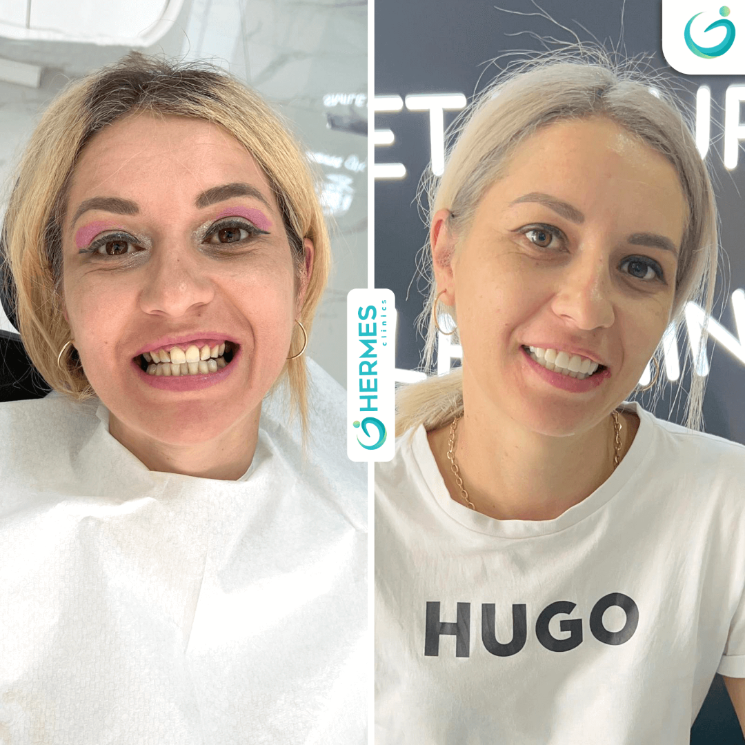 hermes before after (20)