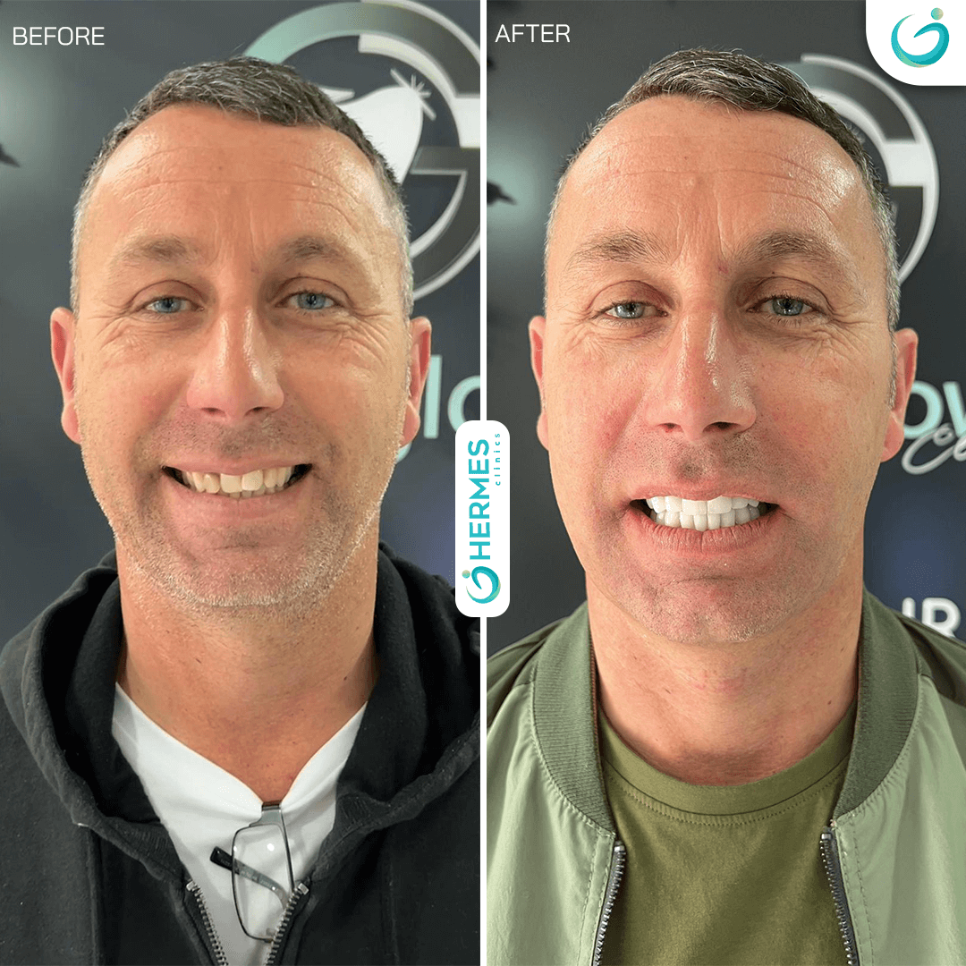 hermes before after (21)