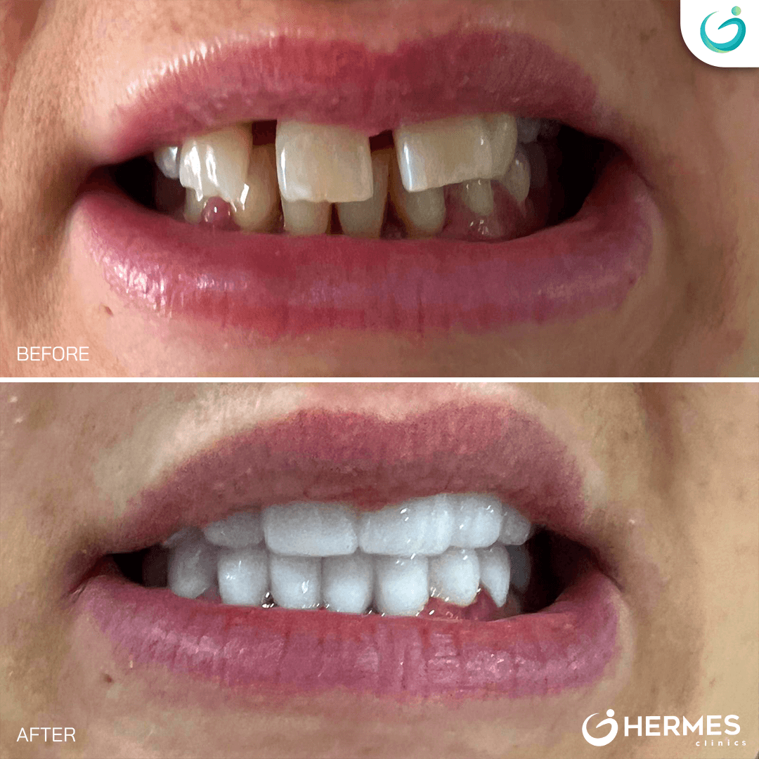 hermes before after (22)