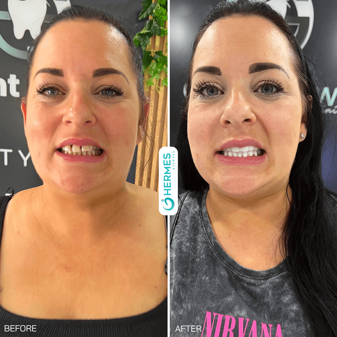 hermes before after (23)