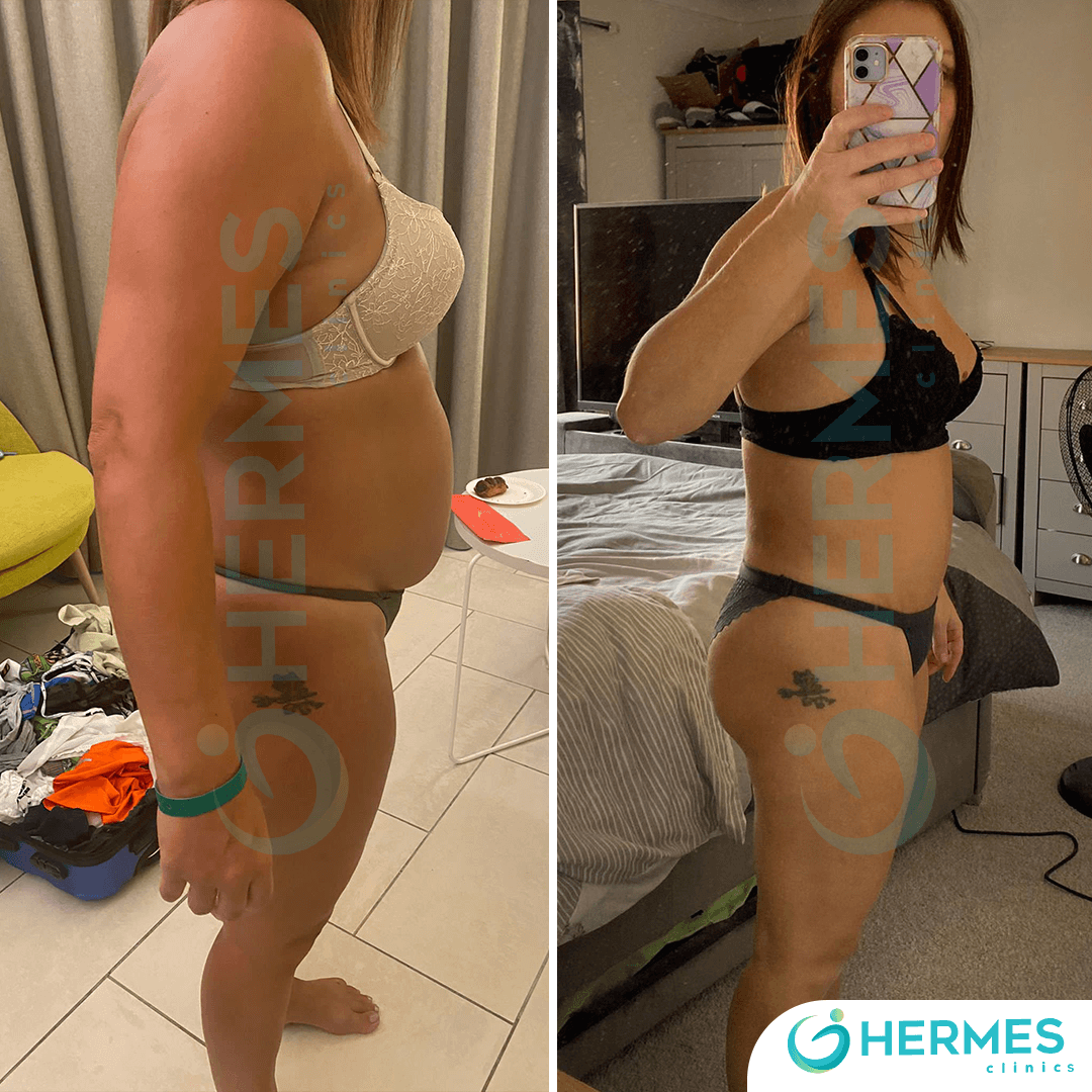 hermes before after (24)