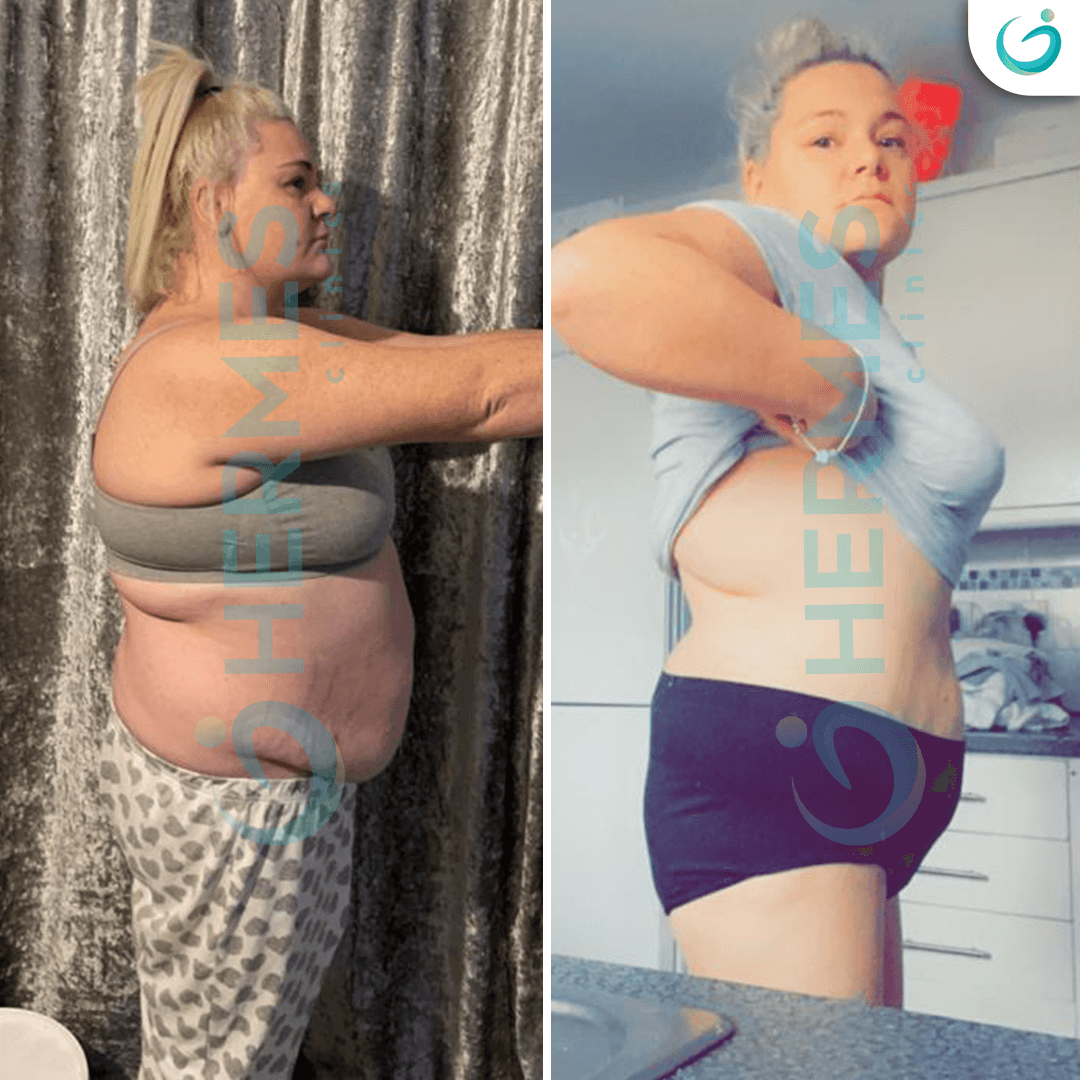 hermes before after (7)