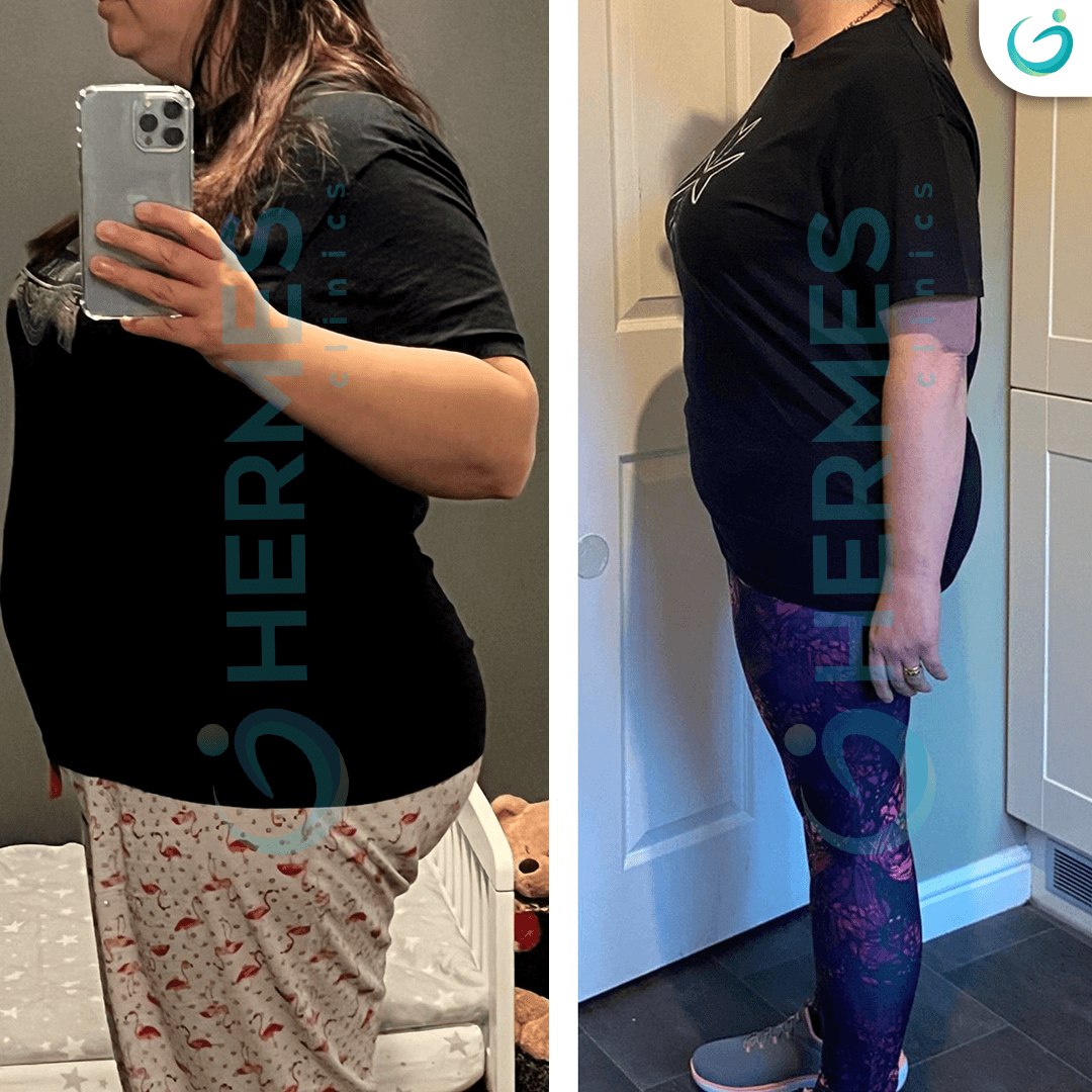 hermes before after (8)