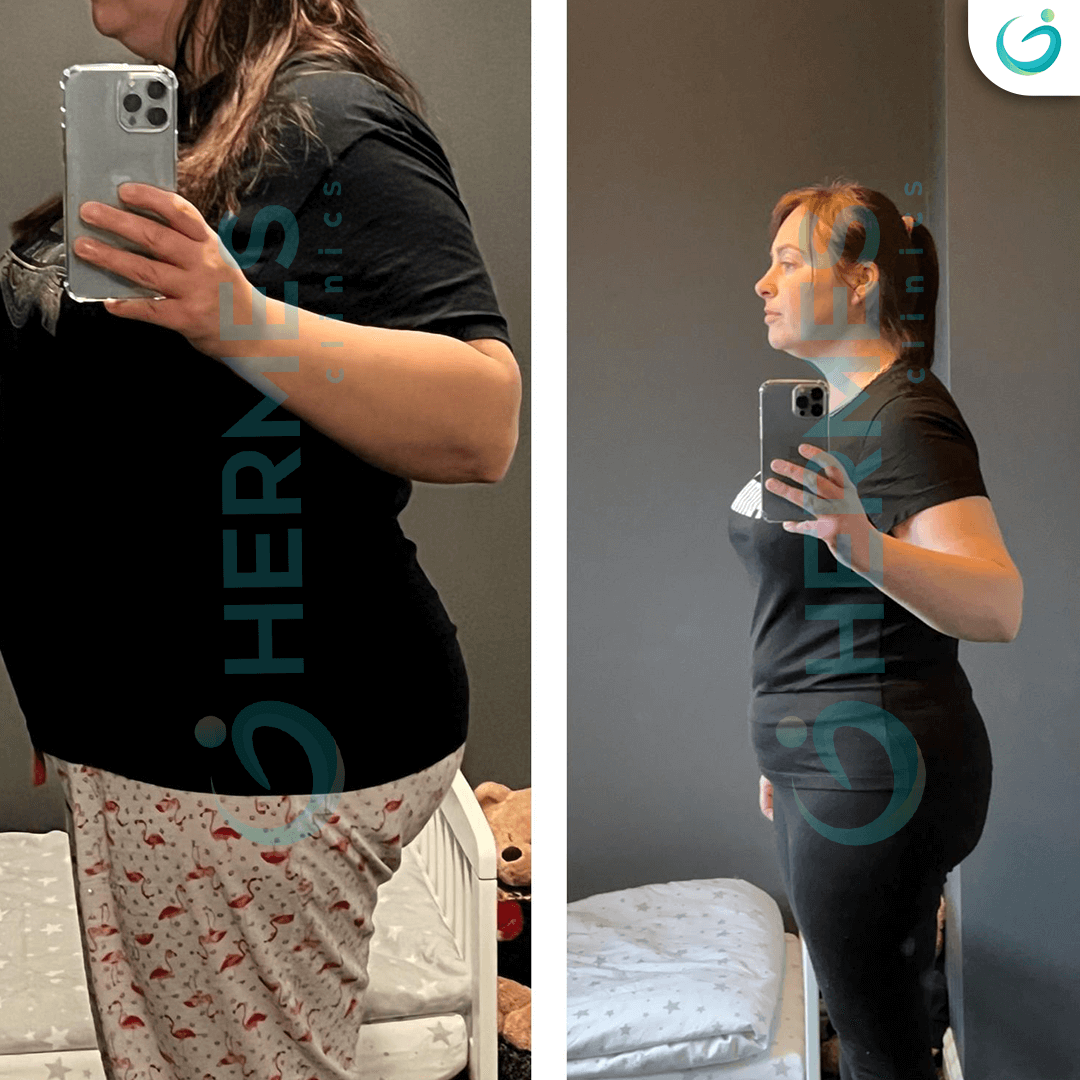 hermes before after (9)