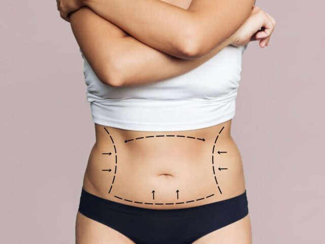 Liposuction in Turkey