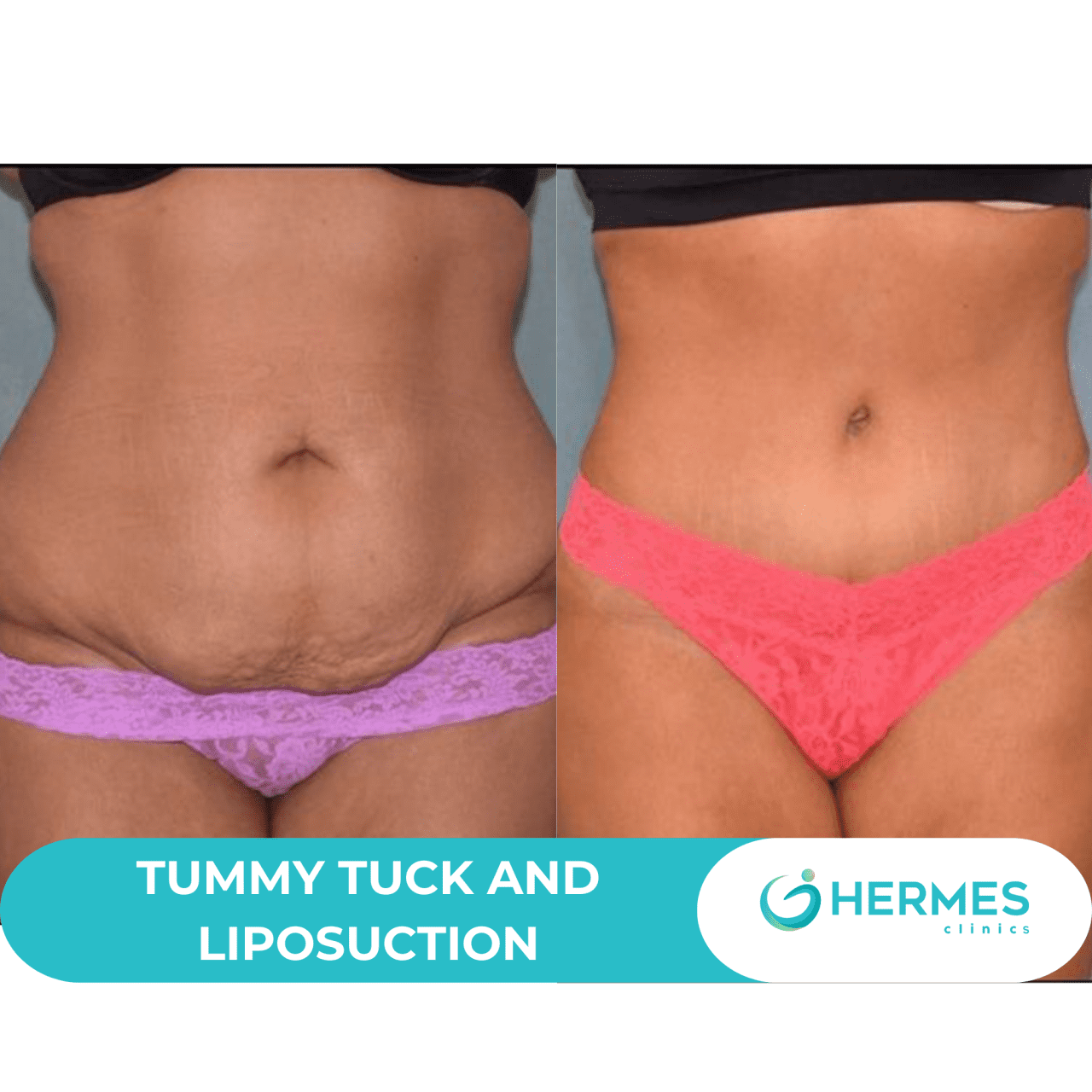 TUMMY TUCK AND LIPOSUCTION (5)