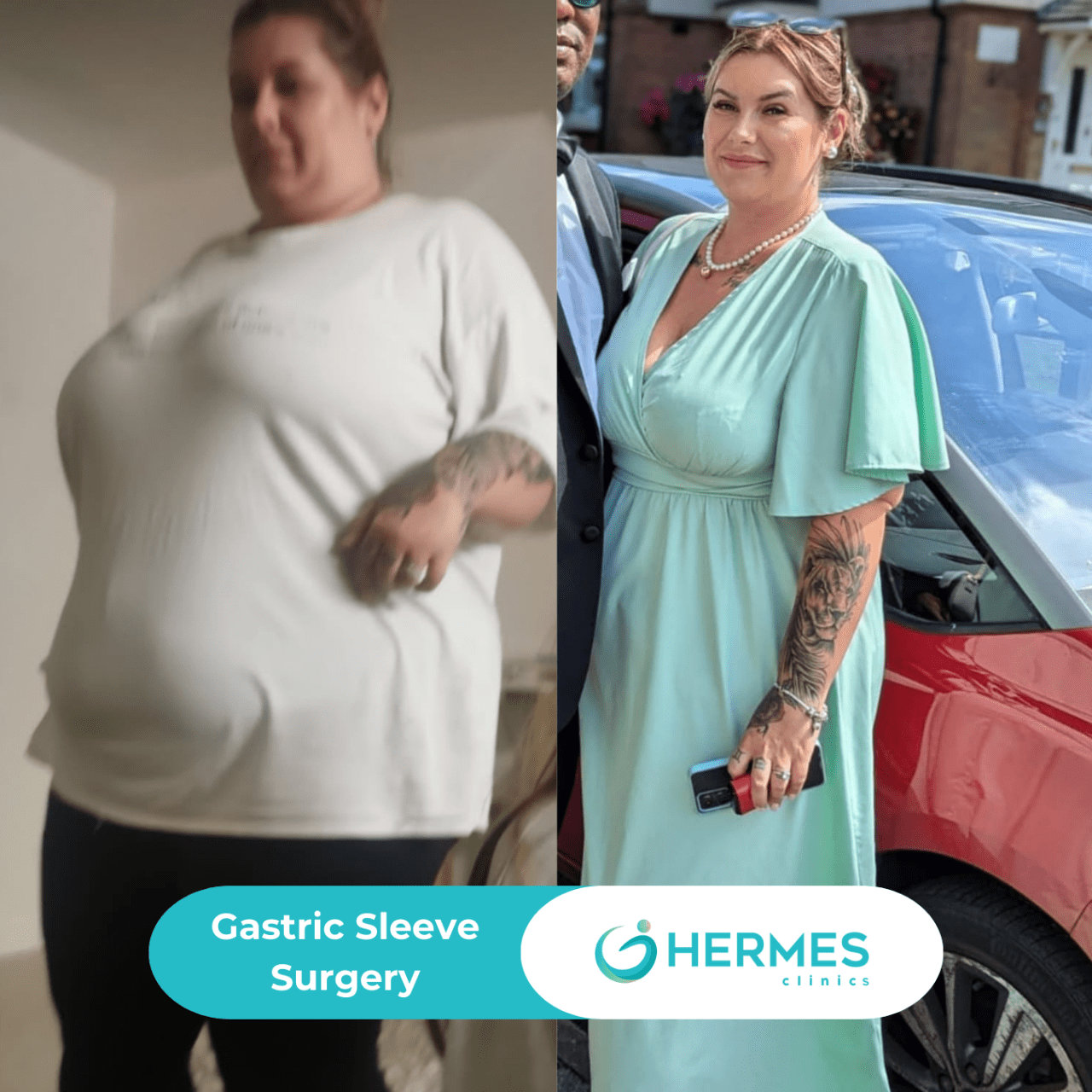 Gastric Sleeve Surgery (56)